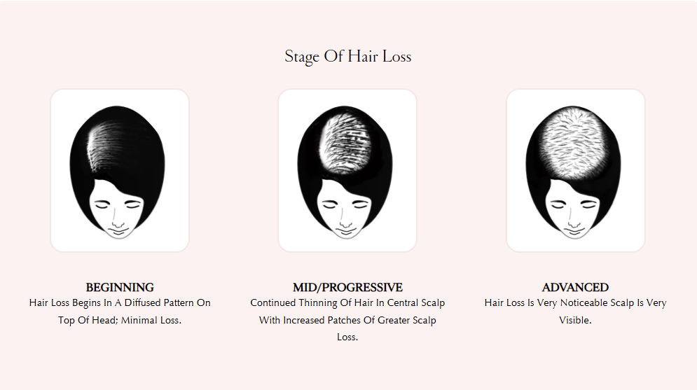 a picture that shows the stage of hair loss